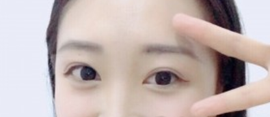 南方医科大学陈兵双眼皮手术怎么样?