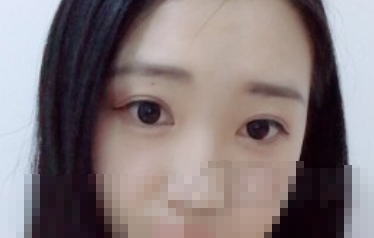 南方医科大学陈兵双眼皮手术怎么样?