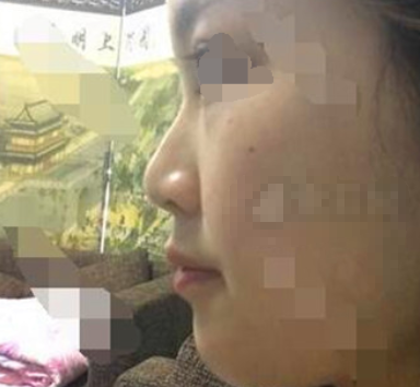 天津伊美尔熊斌做鼻子怎么样,有案例吗?
