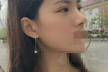 广州瑞港孙瑞霞做鼻子怎么样,有案例吗?