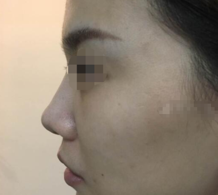 北京煤炭总医院王驰隆鼻怎么样,价格是多少?