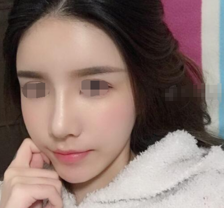 北京煤炭总医院王驰隆鼻怎么样,价格是多少?
