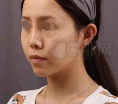 武汉天佑医院田霞隆鼻怎么样,价格多少?