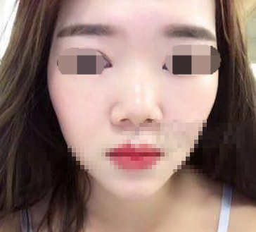深圳北大朱辉隆鼻怎么样,有失败过吗?