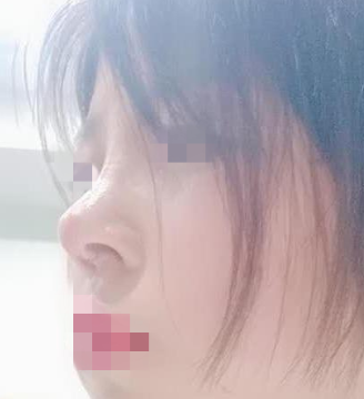 福建星龄王召克隆鼻怎么样,有案例吗?