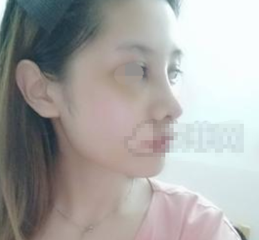 上海美立方谭拯隆鼻案例怎么样,有失败吗?