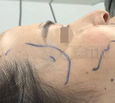 武汉天佑严玲玲做鼻子怎么样,靠谱吗?
