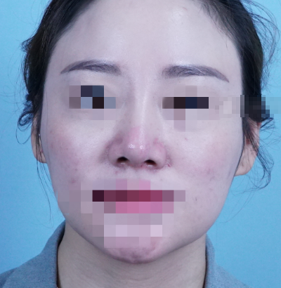 泉州美莱杨红华做鼻子怎么样?鼻修复案例