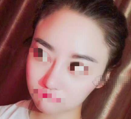 泉州美莱杨红华做鼻子怎么样?鼻修复案例