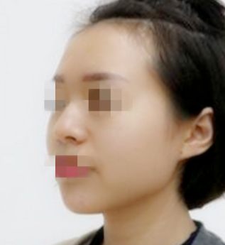上海容妍李昕隆鼻怎么样 失败多吗?