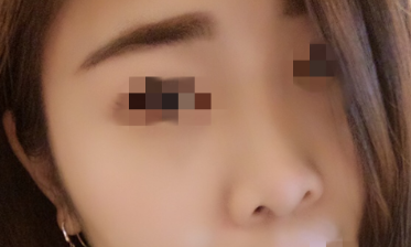 四川华美紫馨徐鹏隆鼻怎么样? 近期案例