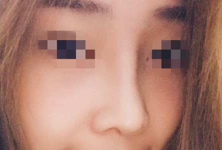四川华美紫馨徐鹏隆鼻怎么样? 近期案例