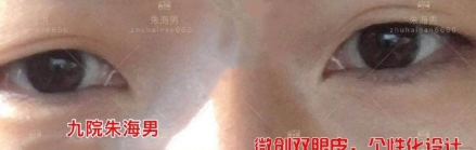 上海九院朱海男双眼皮怎么样 案例有吗?