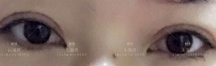 上海九院朱海男双眼皮怎么样 案例有吗?
