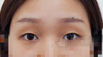广州华美阮庆玲双眼皮案例有吗 价格多少?