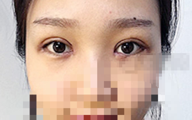 广州华美阮庆玲双眼皮案例有吗 价格多少?