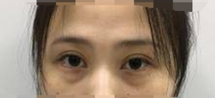 合肥立新赵李平双眼皮怎么样有案例吗?
