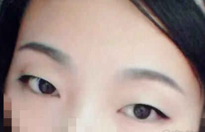 上海九院刘菲双眼皮案例怎么样有价格吗?