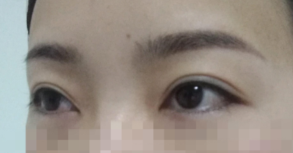 上海九院刘菲双眼皮案例怎么样有价格吗?