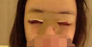 北京八大处杨晓楠双眼皮果怎么样有案例吗？