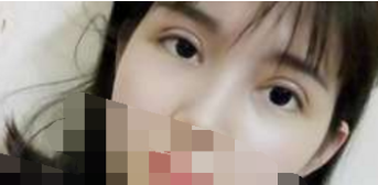 泉州美莱吴细钦双眼皮手术怎么样案例有吗?