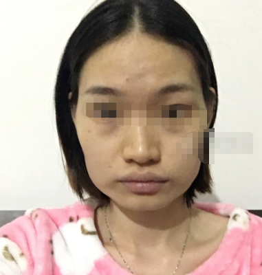 华西口腔李继华做下颌角磨骨怎么样?