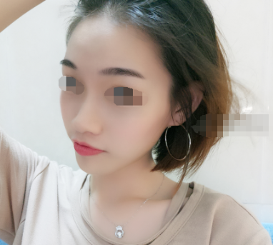 华西口腔李继华做下颌角磨骨怎么样?