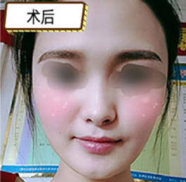 重庆西南医院(万家鸿源)王珍祥下颌角磨骨