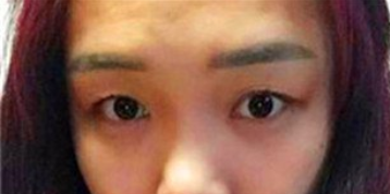 上海九院王梓 朱海男割双眼皮怎么样 哪个医生好