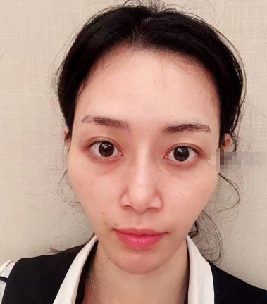苏州美贝尔面部填充做的怎么样？