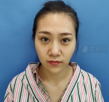 深圳欧亚美何德文面部填充怎么样?