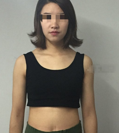 重庆胡小义腰腹吸脂怎么样?有失败案例吗?