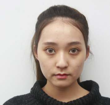 重庆华美潘宝华下颌骨做的怎么样?有案例吗?