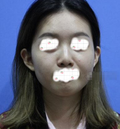 杭州甄美黄庆武硅胶隆鼻怎么样?有案例吗?