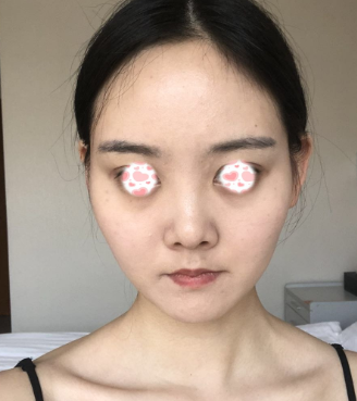 杭州华山连天美高俊明颧骨整形怎么样?