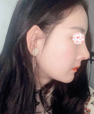 杭州华山连天美高俊明颧骨整形怎么样?
