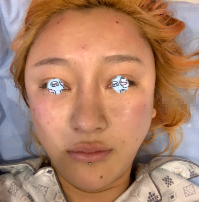 成都润美玉之光刘中国面部填充果怎么样?