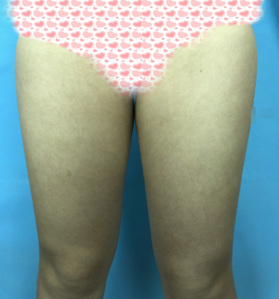 深圳妍熙李静大腿抽脂怎么样?会反弹吗?