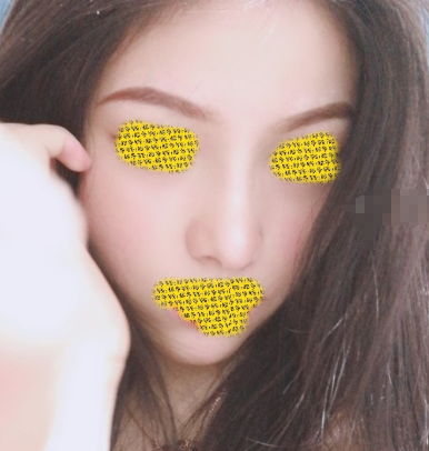 天津美莱于双全软骨隆鼻果怎么样？