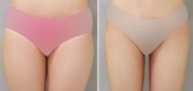 武汉大腿吸脂果怎么样？费用多少？