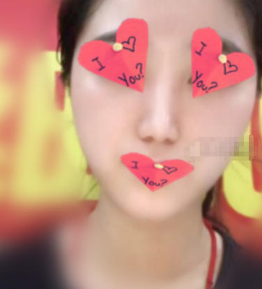 北京艺星美容注射瘦脸案列分享