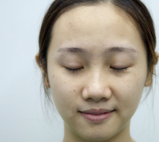 长沙爱思特杨千里做的双眼皮太美了!