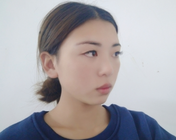 郑州爱美丽整形医生崔黎丹做的双眼皮太美了!