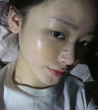 深圳福华医疗美容做“M”型立体鼻子怎么样?