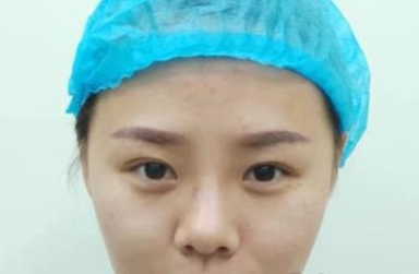 天津亦可美客医疗美容全切双眼皮怎么样?