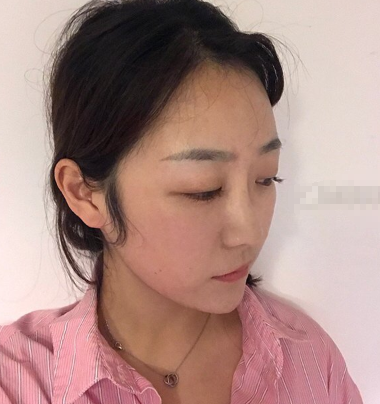 温州和平整形医院梁赞姜医生做的鼻子果