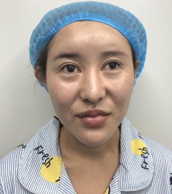 天津菲丝澜医疗美容隆鼻怎么样?隆鼻案例