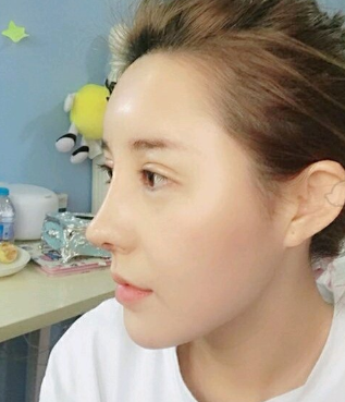 天津菲丝澜医疗美容隆鼻怎么样?隆鼻案例
