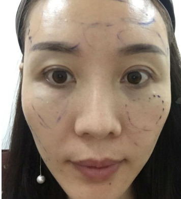 深圳光明医院全脸自体脂肪案例分享!