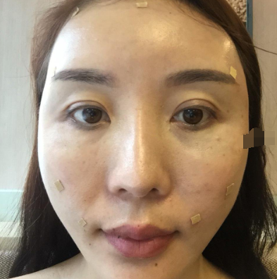 深圳光明医院全脸自体脂肪案例分享!